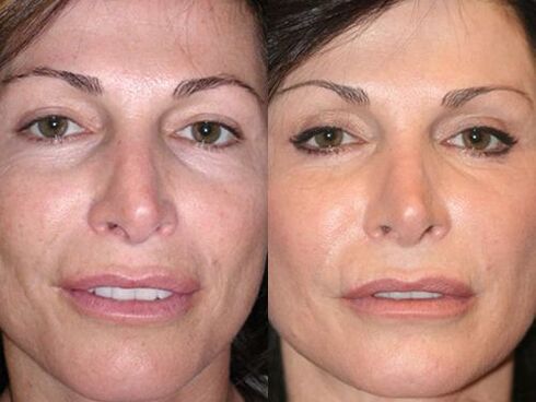 before and after skin rejuvenation with plasma