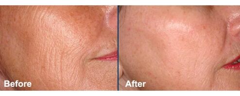 Facial skin before and after the laser rejuvenation procedure