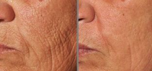 photography before and after fractional skin rejuvenation