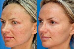 photography before and after skin rejuvenation with the device